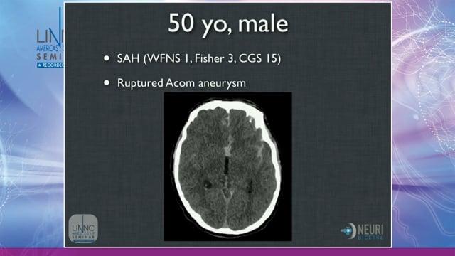 Y stenting with atlas stent for a recanalised Acom aneurysm